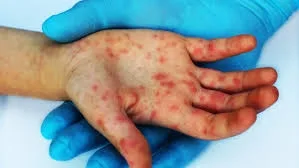 Un copil de doi ani a murit de rujeolă: nu era vaccinat