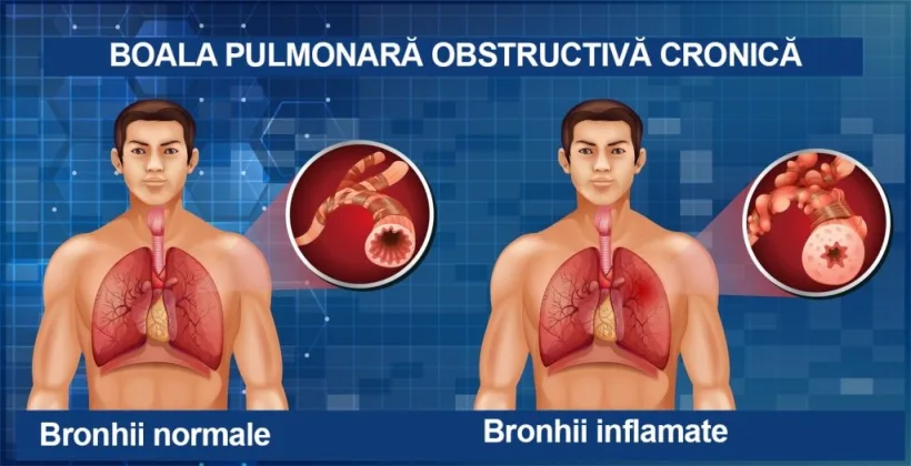 BPOC - a doua cea mai frecventă cauză de spitalizare în regim de urgenţă