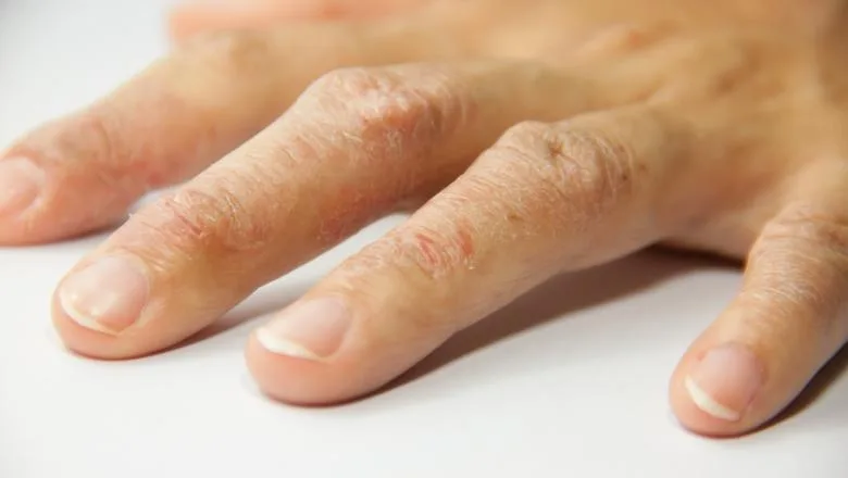 Medicii avertizează că și mănușile din latex și dezinfectanții pot provoca neplăceri